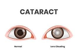 Treatment Methods for Cataracts