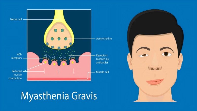 How Myasthenia Gravis Affects Daily Life_ Tips for Managing the Condition.docx